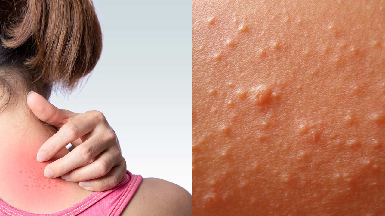 heat-rash-remedies